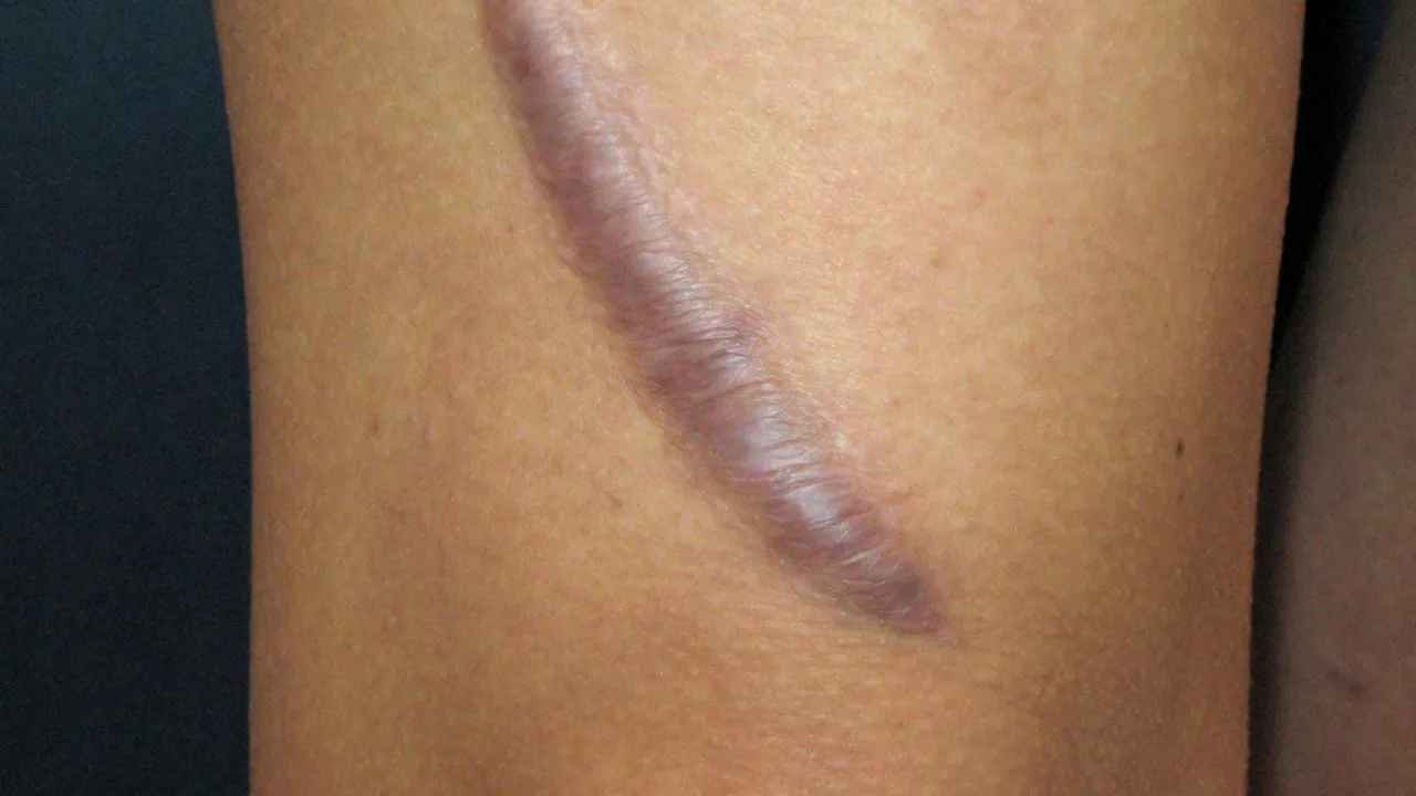 The process of scar tissue removal surgery